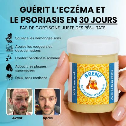 GlacierSkin – Baume Réparateur contre l’Eczéma et le Psoriasis