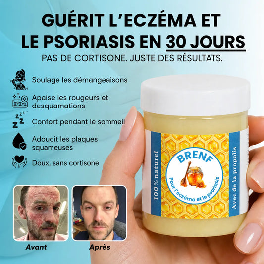 GlacierSkin – Baume Réparateur contre l’Eczéma et le Psoriasis